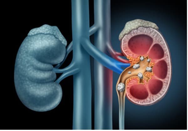 Cartoon image of healthy kidney versus kidney with kidney stones.