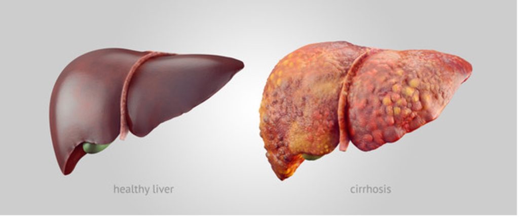 Healthy liver versus liver with cirrhosis.
